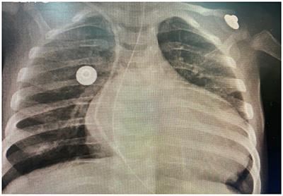 Case Report: Dilated Cardiomyopathy in a Newborn, a Potential Association With SARS-COV-2